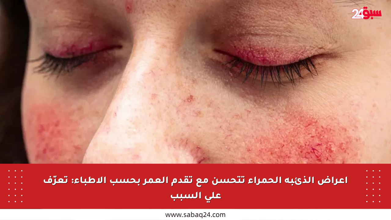 أعراض الذئبة الحمراء تتحسن مع تقدم العمر بحسب الأطباء: تعرّف على السبب